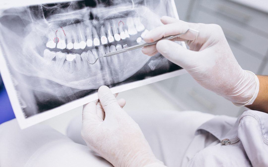Implante dental