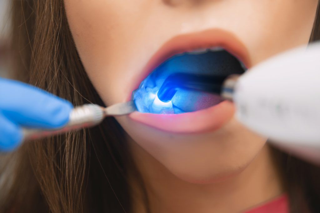 Blanqueamiento dental el mejor