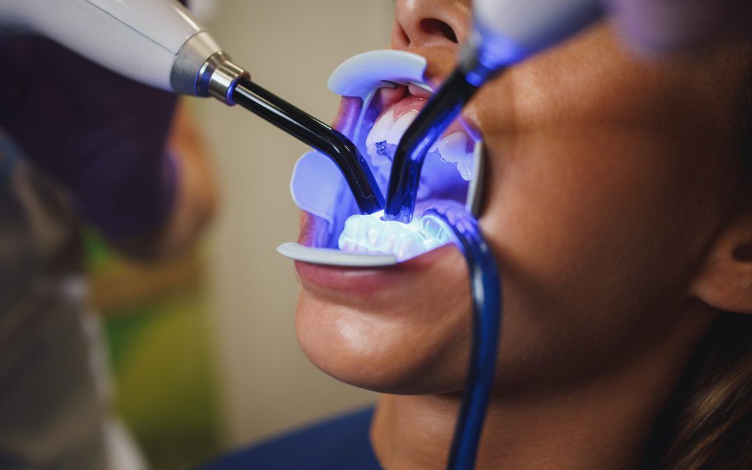 Tratamiento blanqueamiento dental